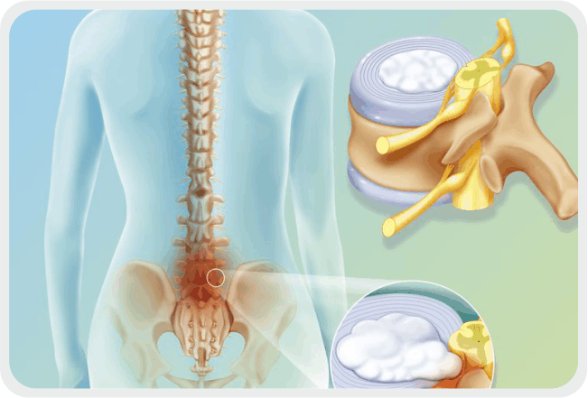 Herniated Disc: Causes, Symptoms, Treatment, and Prevention, ProActive  Physical Therapy Clinics