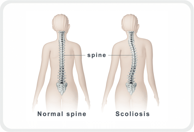 Scoliosis treatment to correct deviations of the spine