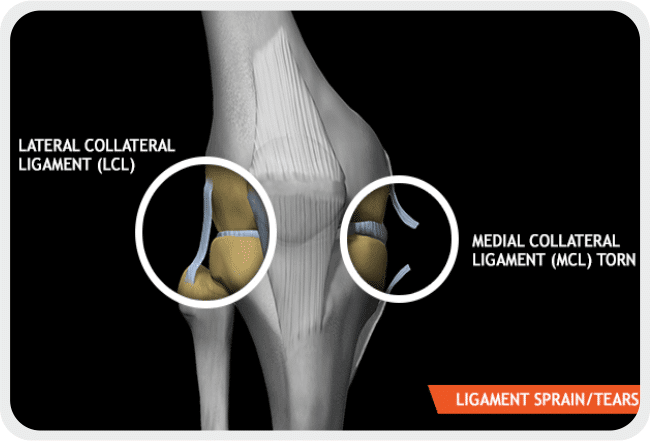 Sprain Treatment in Delhi & NCR | Physiotherapy in Dwarka | AktivHealth