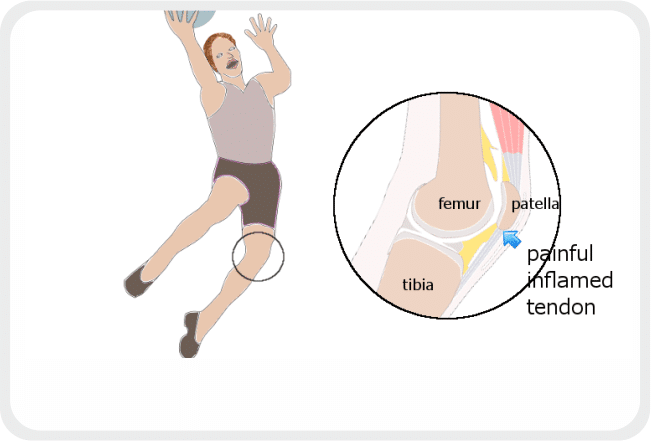 Резултат с изображение за „Jumper’s Knee“